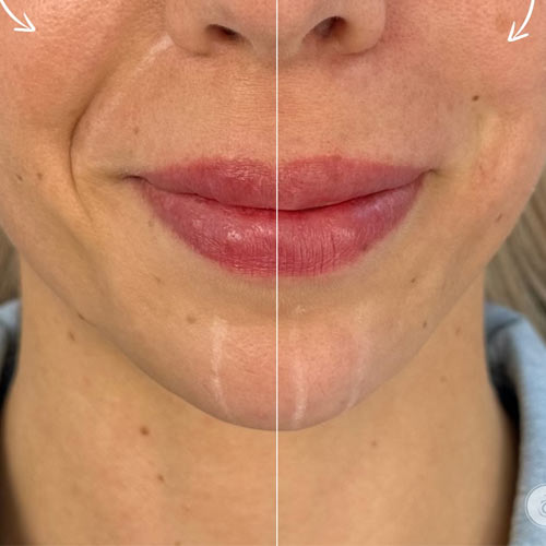 Neus-lippenplooi