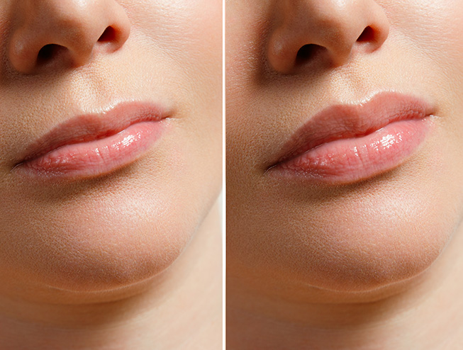 Lip flip resultaat 1