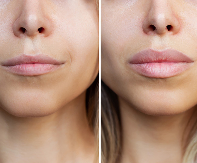Lip flip resultaat 2